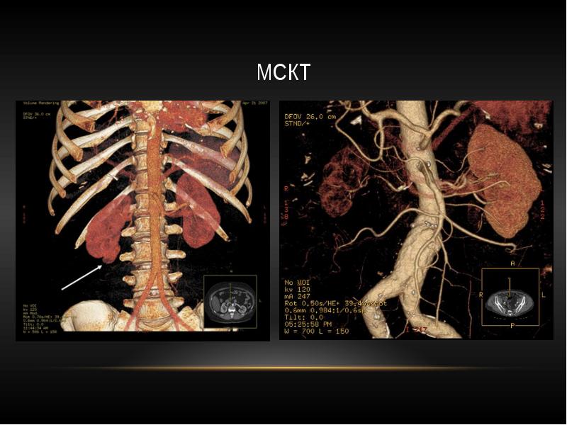 Мскт с контрастированием. Многослойная компьютерная томография (МСКТ). Мультиспиральная компьютерная томография (МСКТ). Мультиспиральная многослойная компьютерная томография. Многослойная спиральная компьютерная томография (МСКТ).