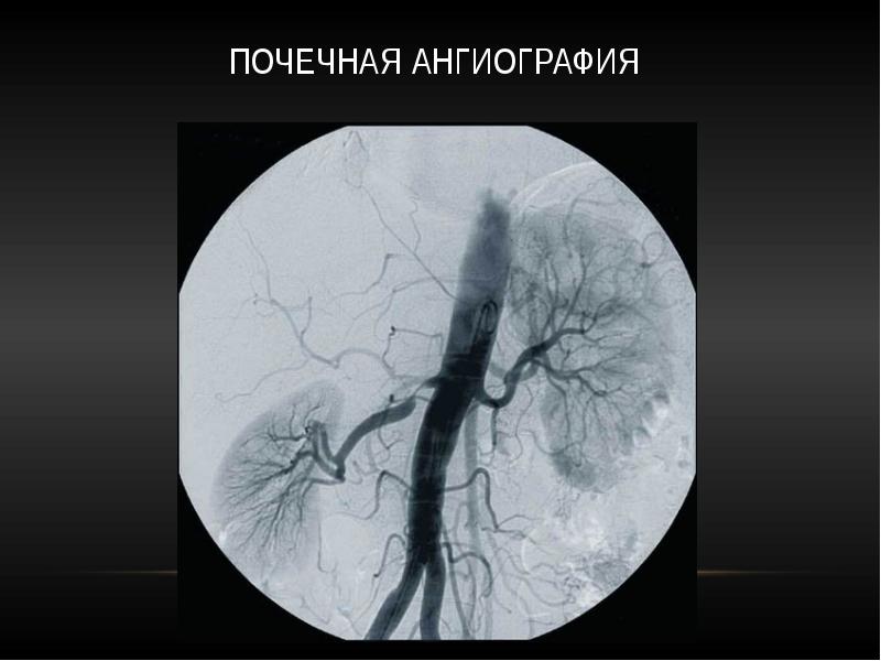 Ангиография сосудов. Селективная ангиография почек. Селективная почечная артериография. Ангиография почечных сосудов. Ангиограмма сосудов почек.