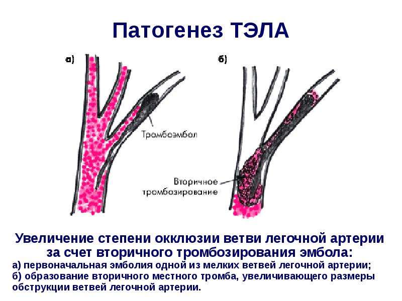 Причины тромбоэмболии артерий. Эмболия мелких ветвей легочной артерии. Тромбоэмболия легочной артерии механизм развития. Тромбоэмболия этиология патогенез. Механизм развития Тэла патофизиология.