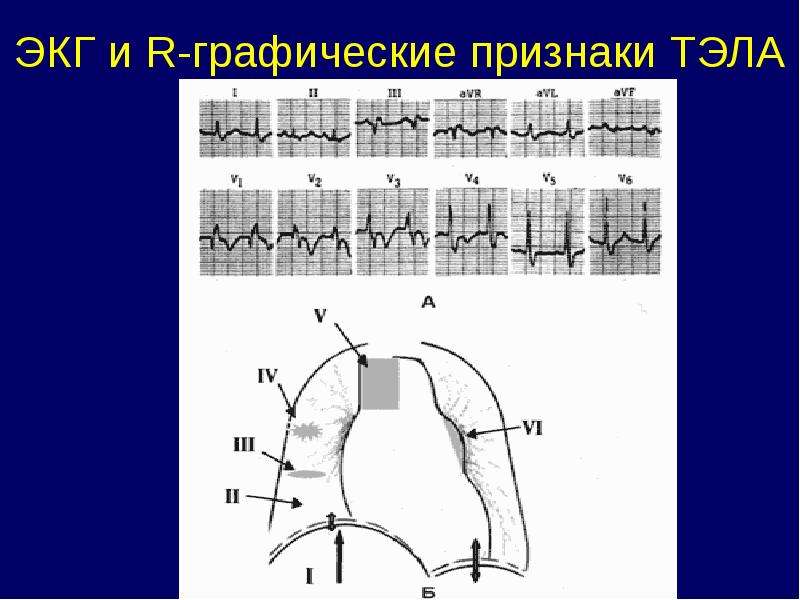 Тэла на экг картинки