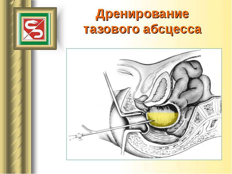 Строение стенки острого абсцесса