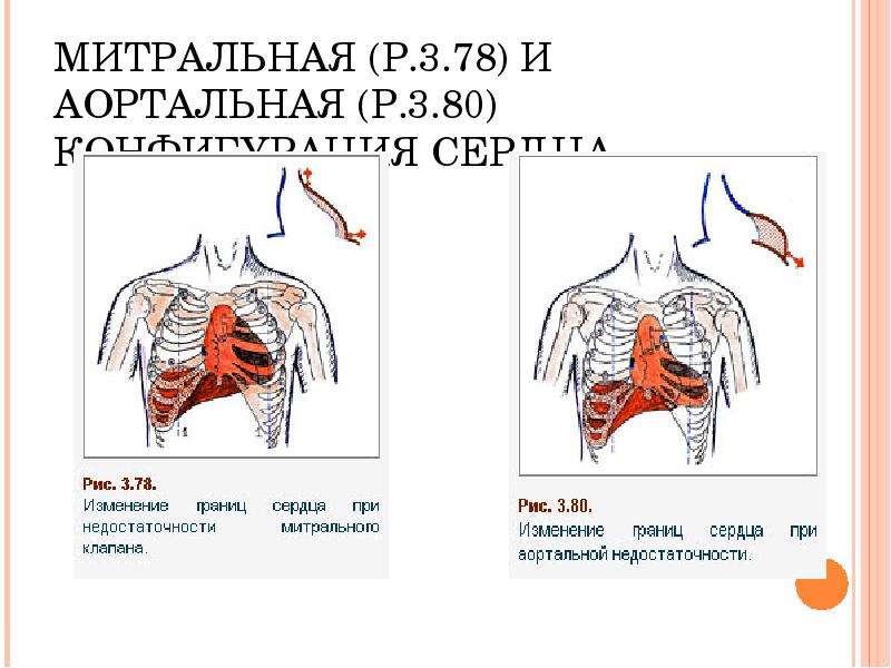 Конфигурация сердца аортальная схема