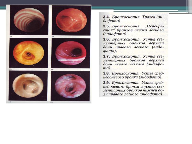 Схема бронхов эндоскопия