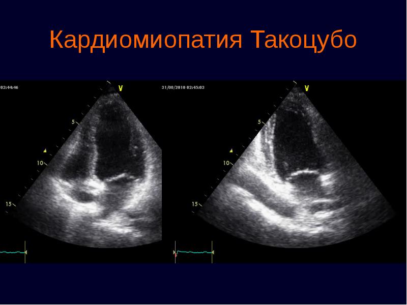 кардиомиопатия такоцубо на экг