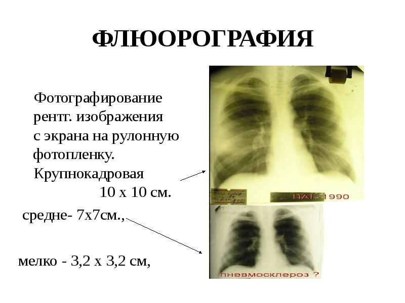 Рентгеновское изображение грудной клетки снятое на фотопленку как называется