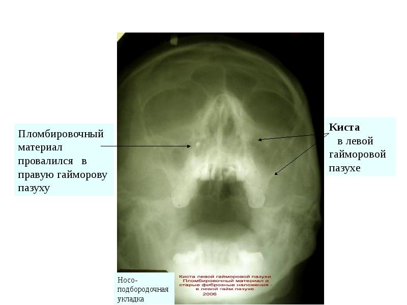 Киста в носу фото рентген