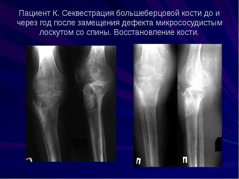 Восстановление костей. Секвестрация кости рентген. Секвестрация при остеомиелите. Секвестр большеберцовой кости. Секвестр кости рентген.