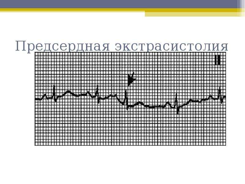 Предсердная экстрасистолия. Рефлекторная предсердная экстрасистолия. Предсердная экстрасистолия причины. Предсердный ритм нарушение проводимости.