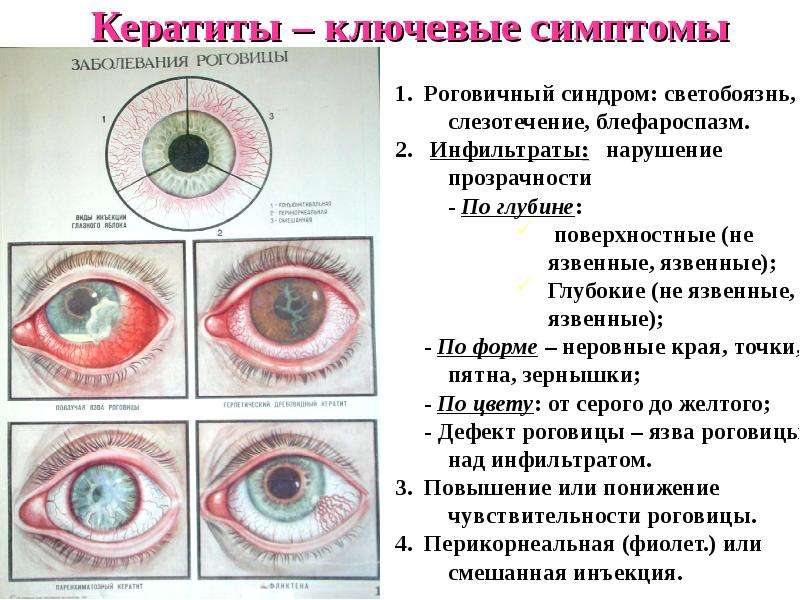 Заболеваниями заболеваний глаз появиться. Клинические проявления кератита. Кератит (воспалительный процесс в роговице глаза)..