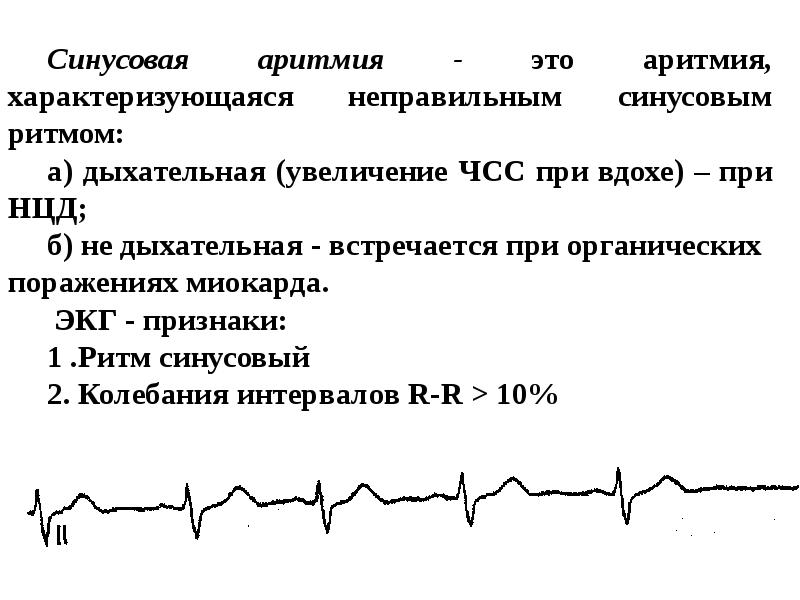 Что значит синусовый ритм сердца на экг. Синусовая аритмия ЭКГ признаки. Синусовая аритмия на ЭКГ. ЭКГ критерии синусовой аритмии. Недыхательная синусовая аритмия на ЭКГ.