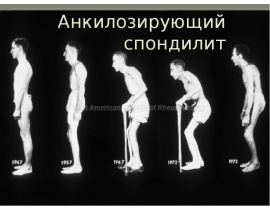 Анкилозирующий спондилит
