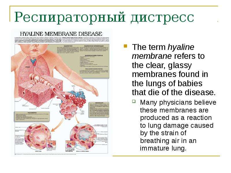 Респираторный дистресс синдром The term hyaline membrane refers to the clear, glassy membranes found
