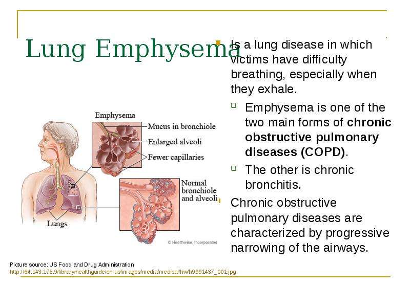 Lung Emphysema Is a lung disease in which victims have difficulty breathing, especially when they ex