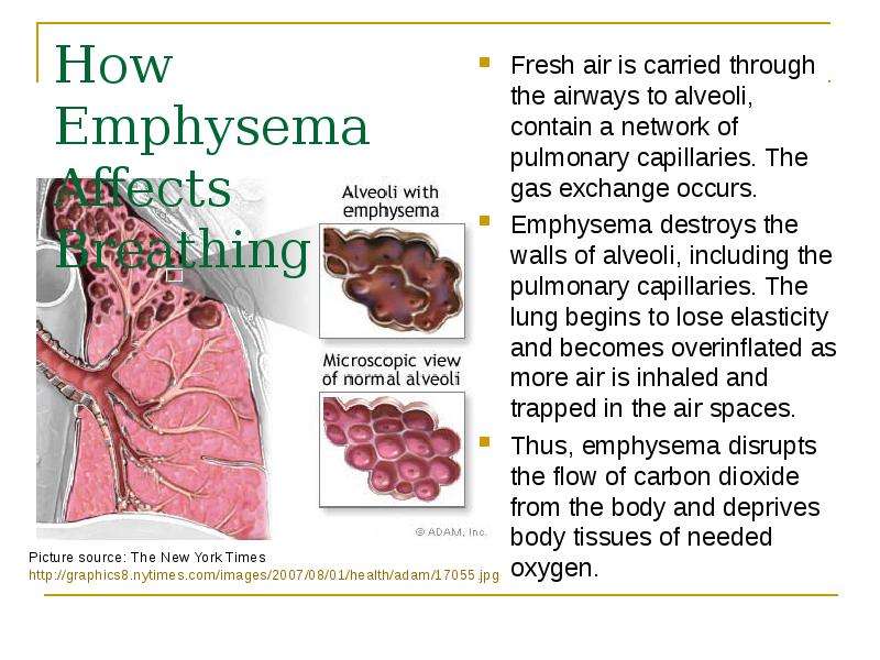 How Emphysema Affects Breathing Fresh air is carried through the airways to alveoli, contain a netwo