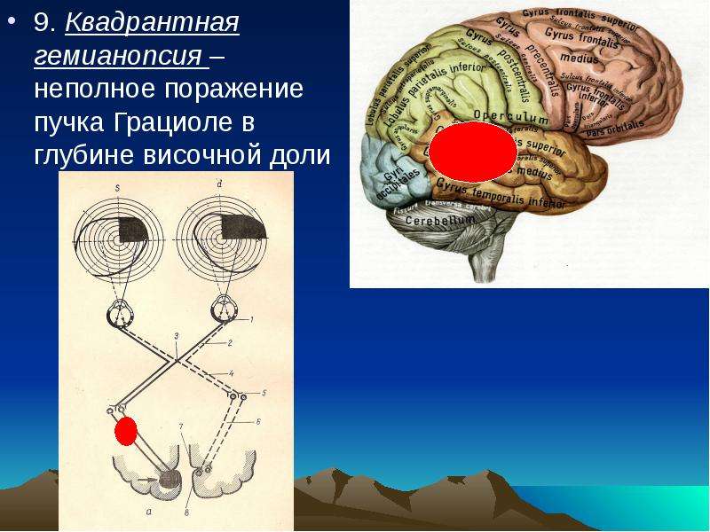 Поражение полушария. Поражение пучка Грациоле. Квадратная Гемианопися. Квадрантная гемианопсия. Зрительный пучок Грациоле.