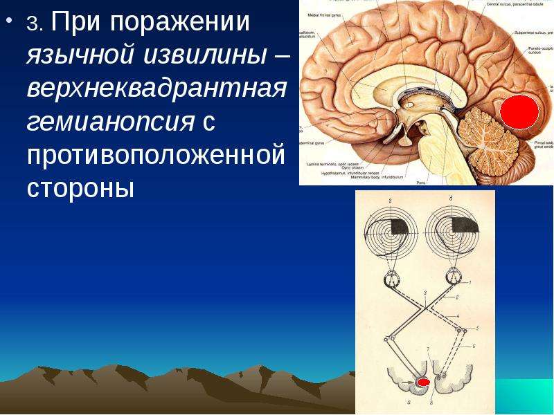 Поражение полушария. Поражение язычной извилины. Язычная извилина. Гемианопсия при поражении височной доли. При поражении язычной извилины наблюдается.