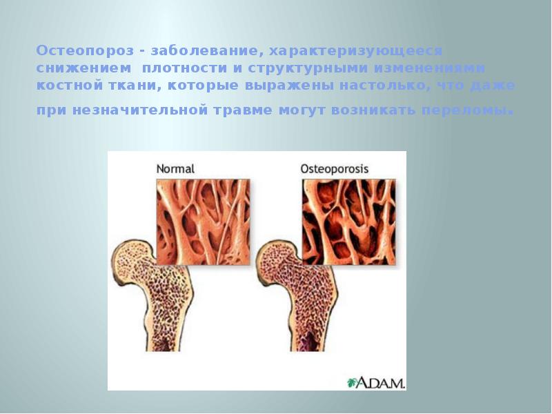 Презентация по теме остеопороз