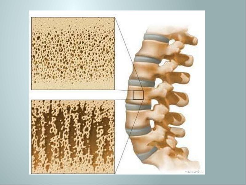 Остеопороз позвоночника фото