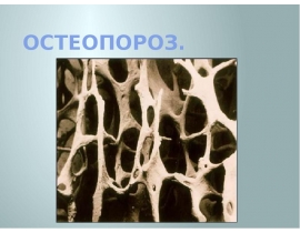 Остеопороз