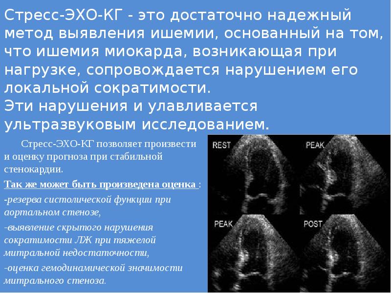 Стресс эхокг презентация