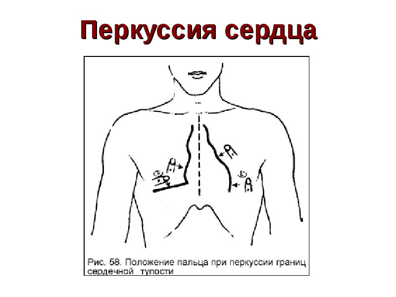 Перкуссия тупости сердца. Методика перкуссии сердца. Перкуссия сердца пропедевтика схема. Перкуссия сердца точки перкуссии. Точки перкуссии сердца у детей.