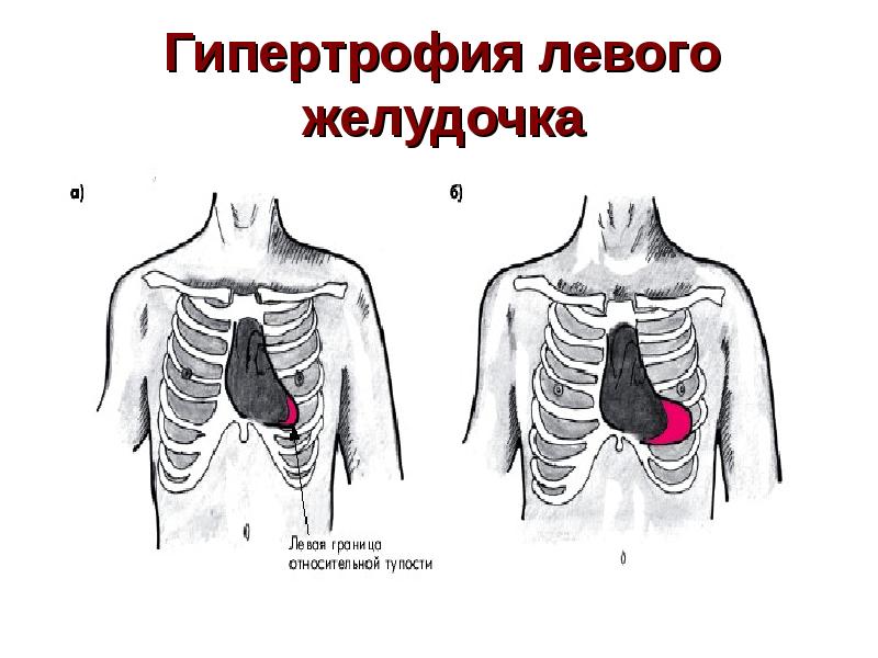 Схема гипертрофия левого желудочка