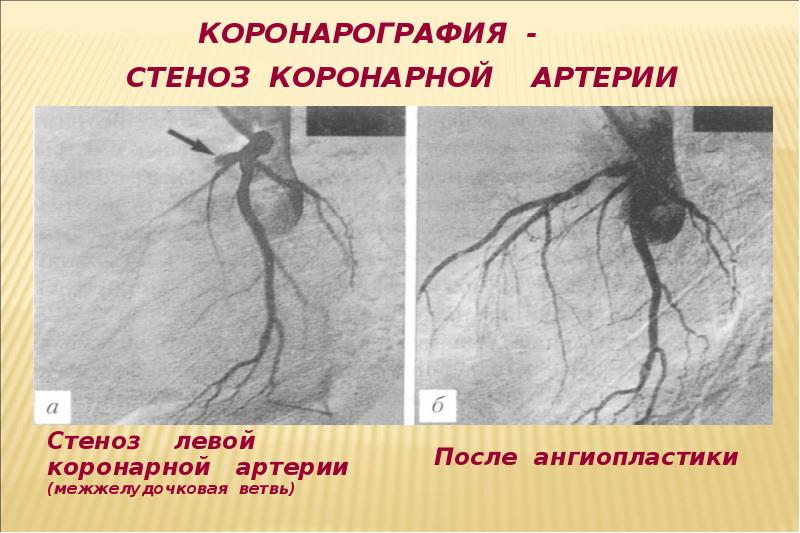 Сосуды сердца схема коронарография