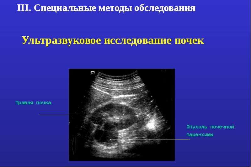 Опухоли общая хирургия презентация