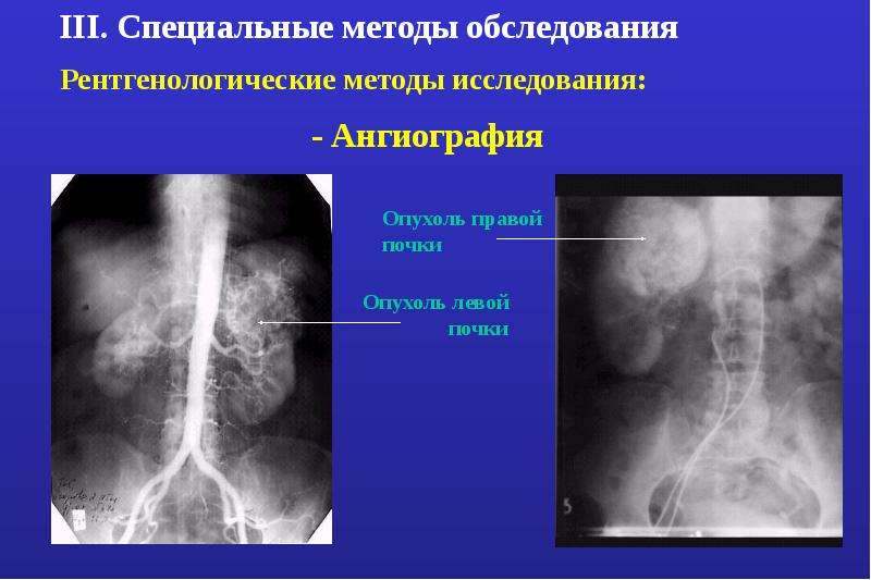 Опухоли патанатомия презентация