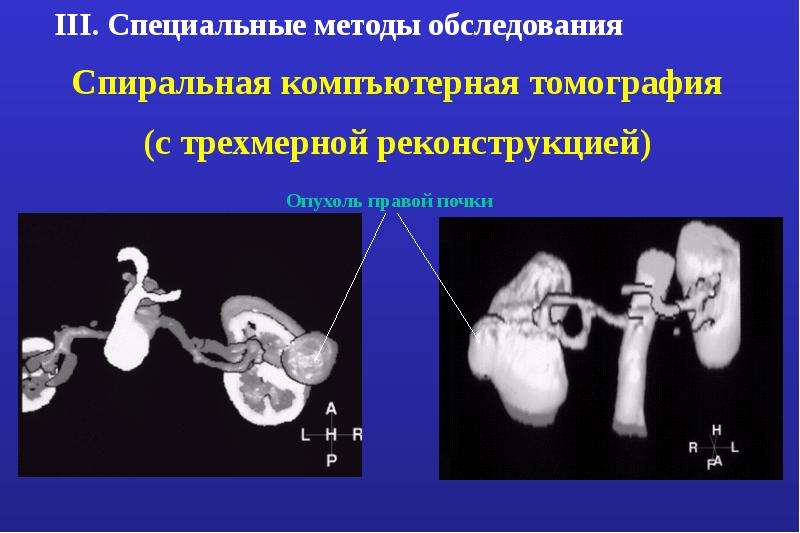 Опухоли патанатомия презентация