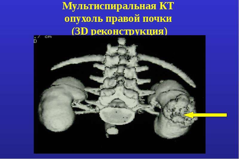 Рак правого. Мультиспиральная кт почек опухоль. Объемные образования почек кт. Объемное образование правой почки.