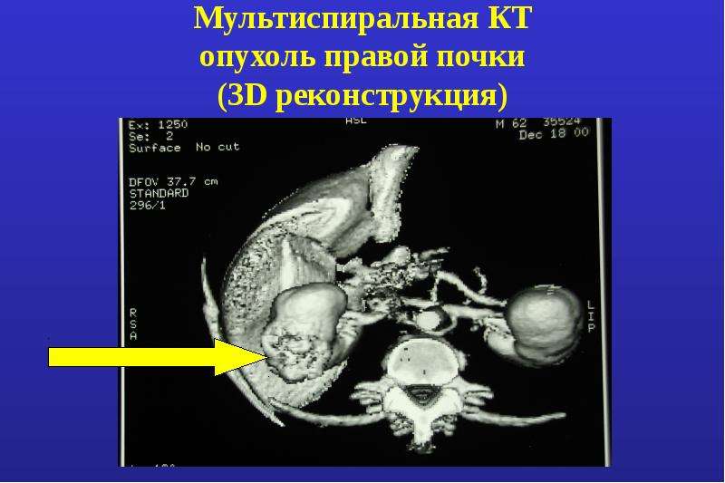 Опухоли почек презентация