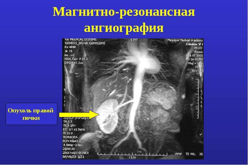 Опухоль почечной лоханки презентация