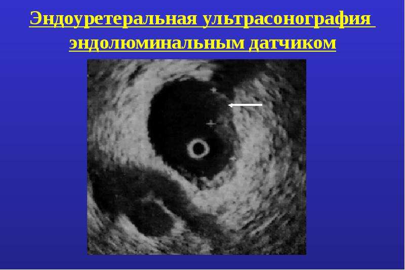 Опухоль почечной лоханки презентация