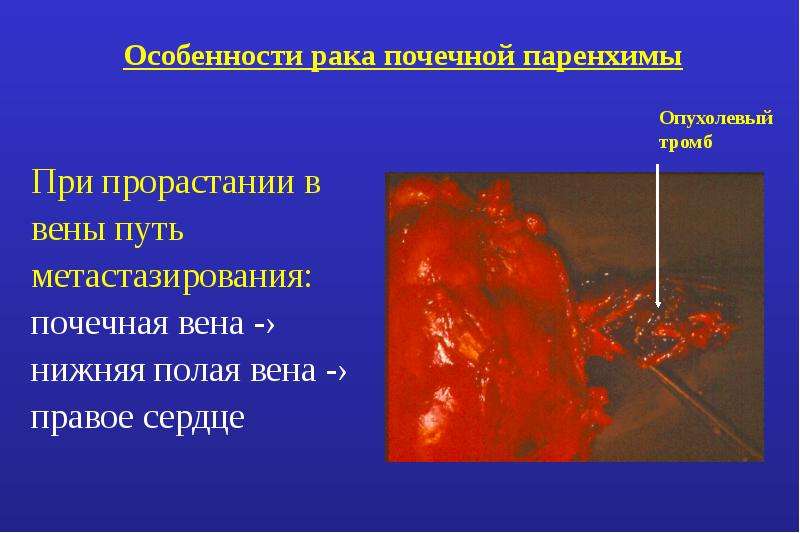 Опухоли патанатомия презентация