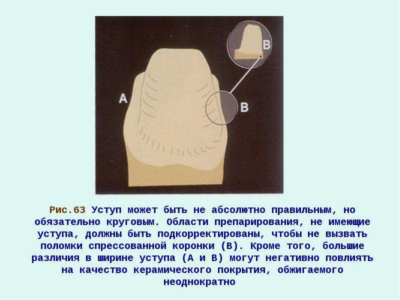 Препарирование под металлокерамическую коронку с уступом в картинках