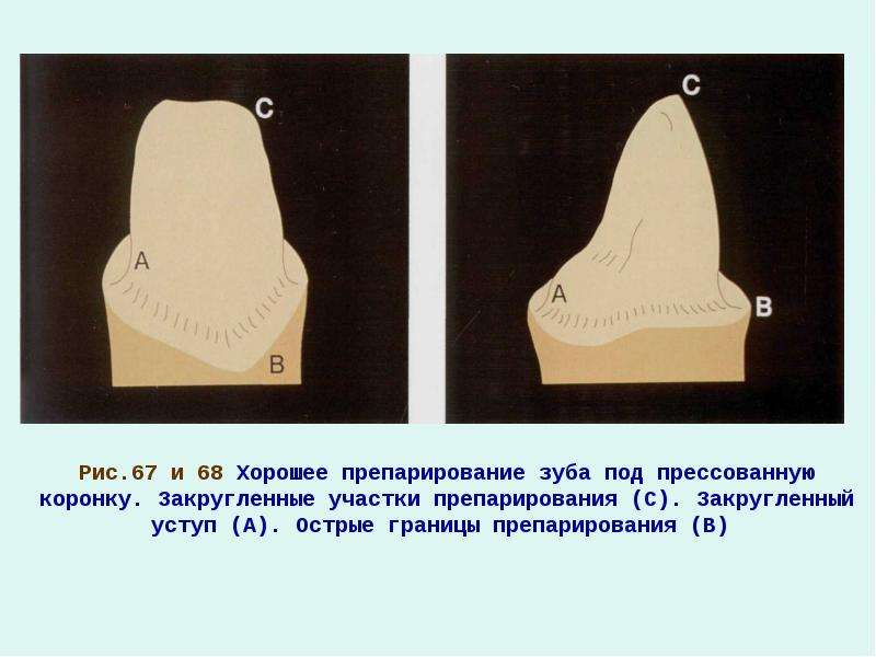 Препарирование зуба. Уступ при препарировании зуба под фарфоровую коронку. Препарирование под фарфоровую коронку. Препарирование зубов под фарфоровую коронку. . При препарирование зубов под фарфоровую коронку.