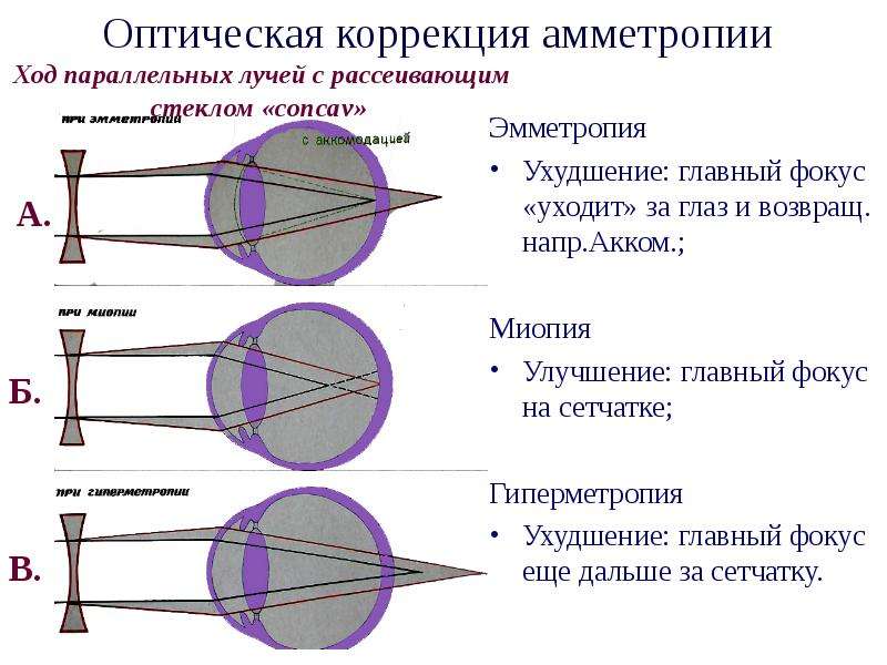 На рисунке приведены схемы хода лучей в глазе при близорукости и дальнозоркости которая из этих