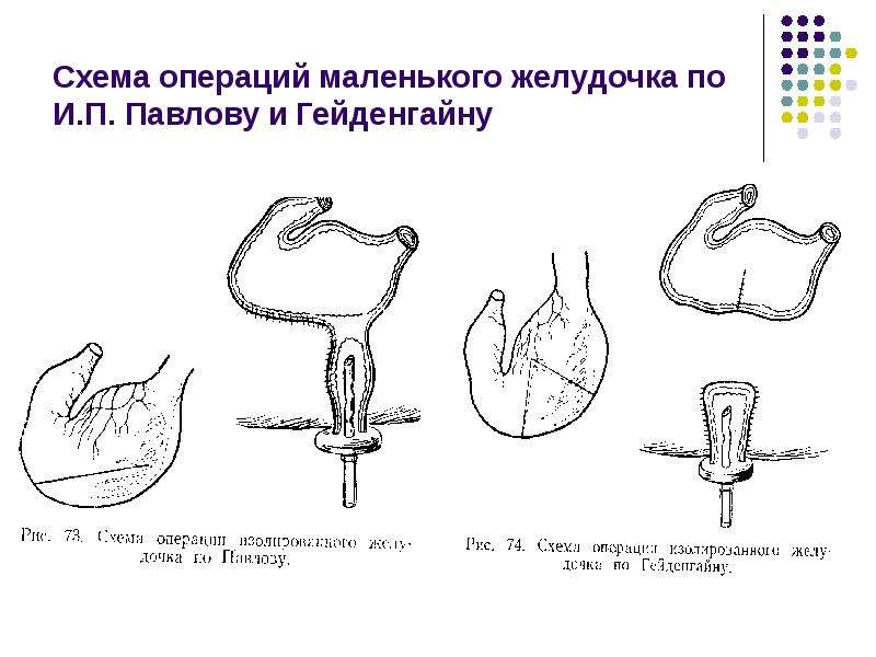 Схема операции изолированного желудочка по гейденгайну и по павлову