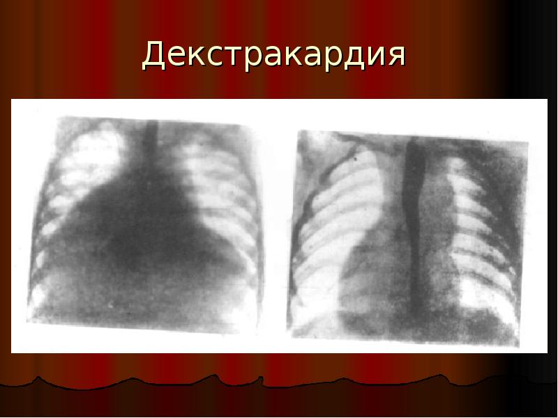 Правосторонняя дуга аорты рентген. Декстракардия является. Зеркальная форма декстракардии.