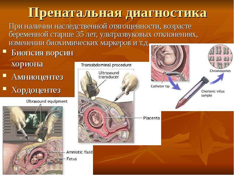 Методы пренатальной диагностики презентация генетика