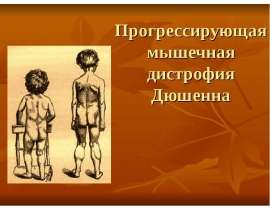 Дистрофия Дюшенна