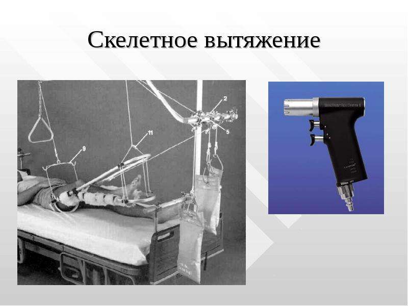 Скелетное вытяжение. Пулевые щипцы скелетное вытяжение. Аппарат для скелетного вытяжения. Скелетное вытяжение руки. Скелетное вытяжение презентация.