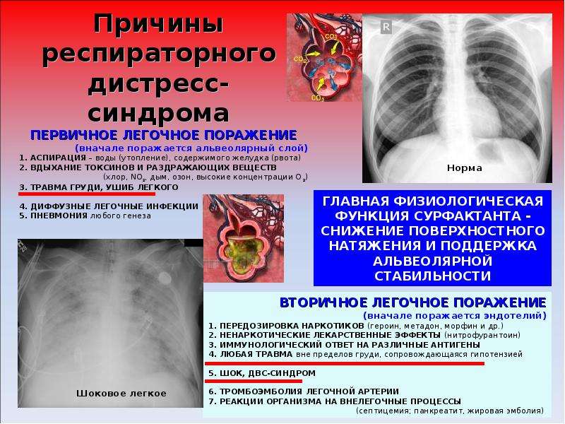 Уплотнение легкого при ордс связано