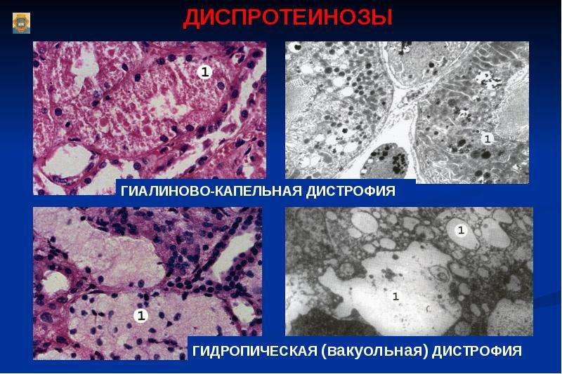 Дистрофия патология обмена веществ презентация