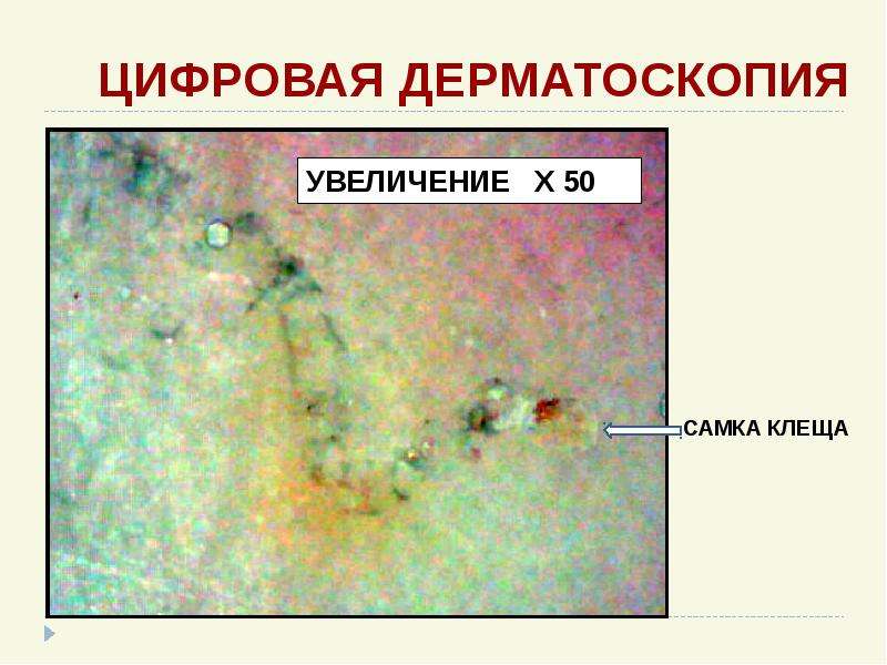 Презентация на тему чесотка