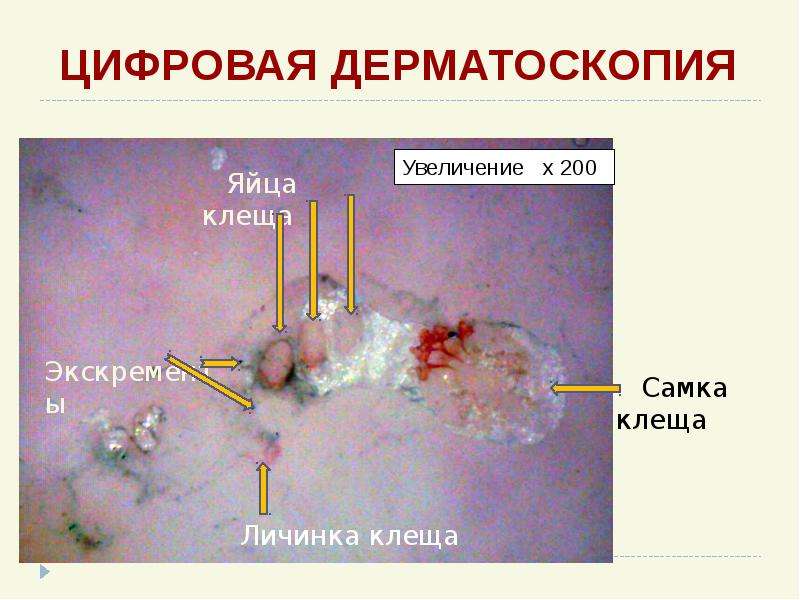 Презентация чесотка дерматовенерология