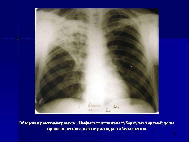 Инфильтративный туберкулез легких. Инфильтративный туберкулез рентгенограмма. Инфильтративный туберкулез правого легкого в фазе инфильтрации. Рентген инфильтративного туберкулеза. Инфильтративный туберкулез перисциссурит.