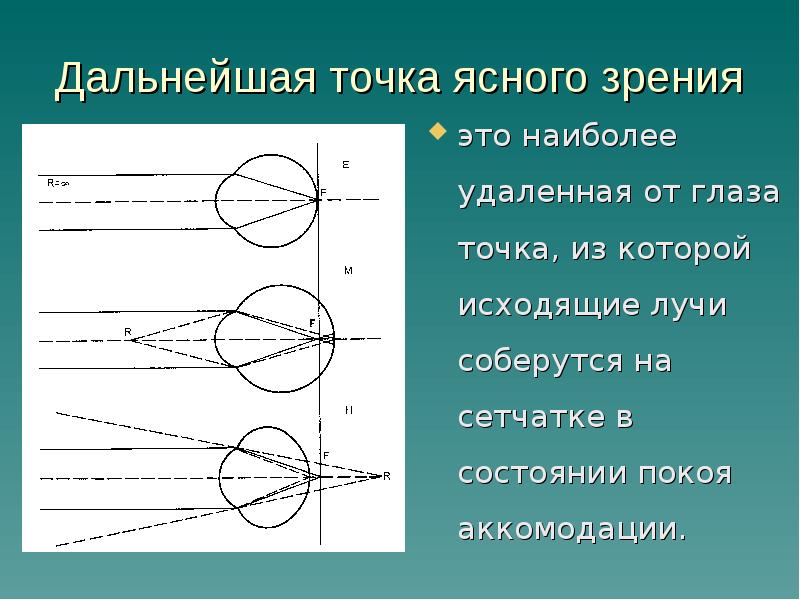 Состояние покоя аккомодации фокус на сетчатке рисунок