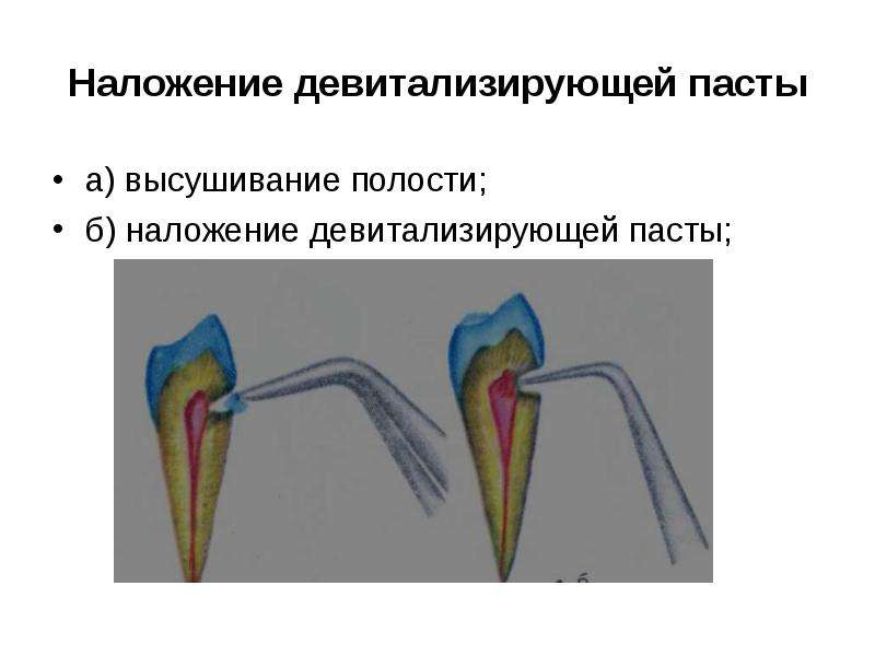 Экстирпация пульпы. Методика наложения девитализирующей пасты. Наложение параформальдегидной пасты. Методика наложения мышьяковистой пасты. Этапы наложения девитализирующей пасты.